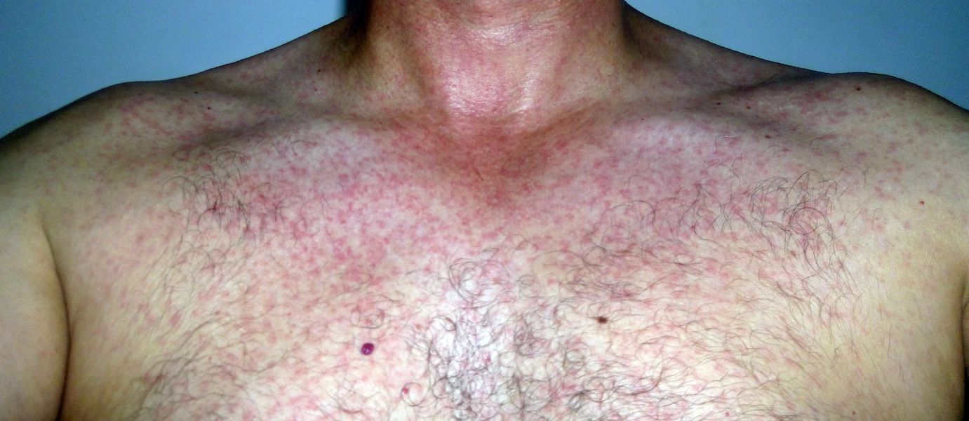 Hautausschlag beim Zika-Virus: Symptome und Behandlung.