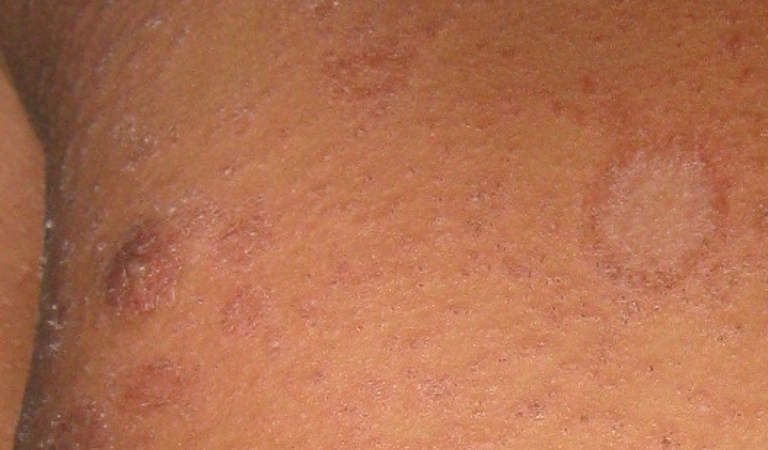 Röschenflechte (Pityriasis rosea) - Symptome und Therapie 